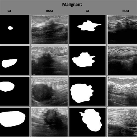 Breast Cancer Ultrasound Images BUSI Including Benign Malignant