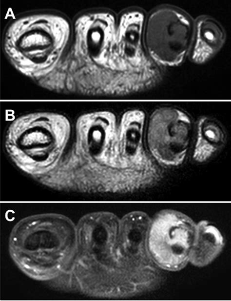 T 1 2 Positive Localized Tenosynovial Giant Cell Tumor With Bone