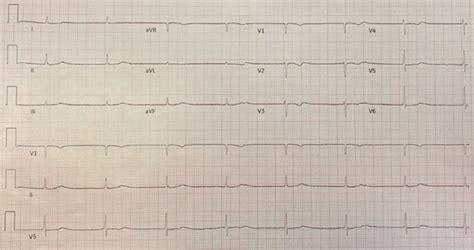 Junctional Escape Rhythm American College Of Cardiology