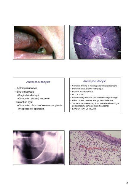 Antral Pseudocyst