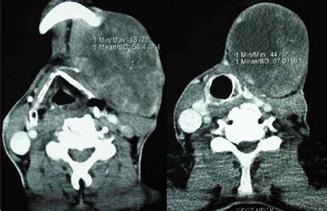 Giant Presentation Of Pleomorphic Adenoma In Major Salivary Gland Bmj Case Reports