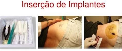 Implantes Hormonais Em Diamantina Dr Renato Andrade