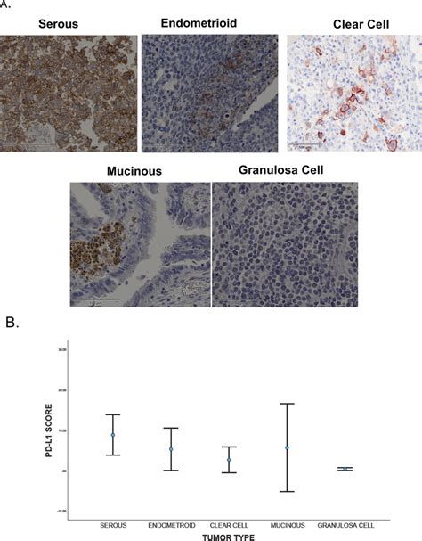 Pd L Expressions In Ovarian Cancer A Immunohistochemistry Staining