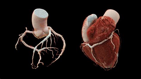 Triple Vessel Coronary Disease With Multiple Stents Siemens Healthineers