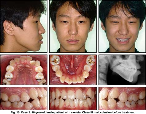 Figure 12 From Treatment Of Class III Relapse Due To Late Mandibular