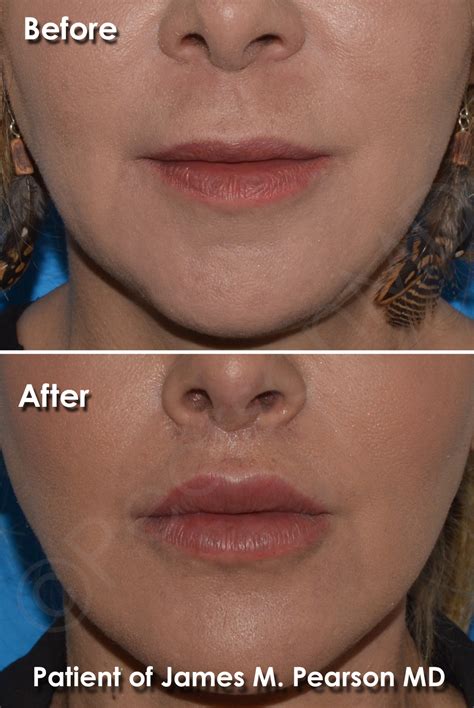 Lip Lift Photos Before And After Dr James Pearson Facial Plastic Surgery