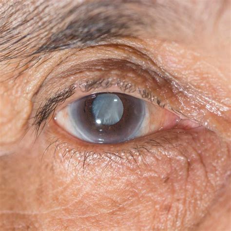 Laser Treatment An Option For Cataract Removal Mayo Clinic News Network