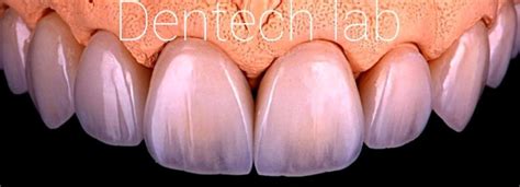 Dentech Lab On Linkedin Dentechlab Dentistry Dentist