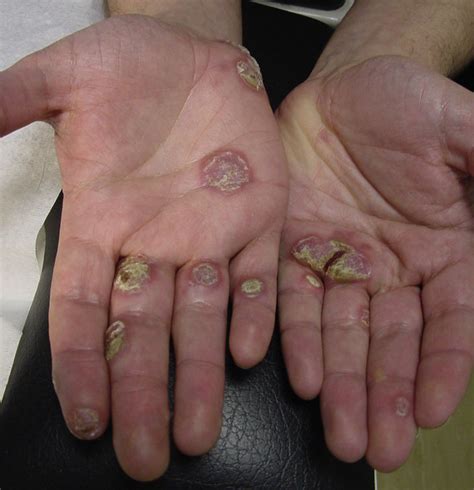 Clavi Syphilitici Palmar Hyperkeratotic Plaques And Erythematous