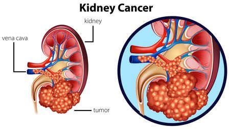 Tipos de cáncer urológico Estilo de Vida Saludable