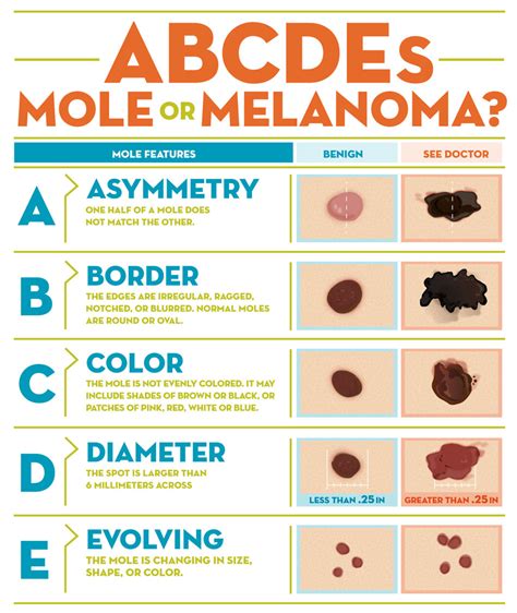 Melanoma Abcde Rule