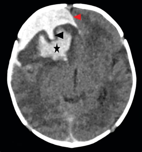 Subpial Hemorrhage In Neonates What Radiologists Need To Know Ajr