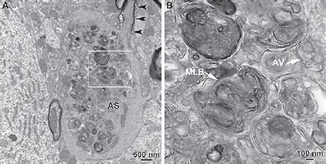 Transmission Electron Microscopic Analysis Of Axonal Spheroids In The