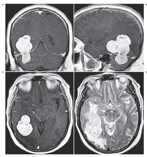 Figure 1 From Onyx Embolization Of An Intracranial Hemangiopericytoma