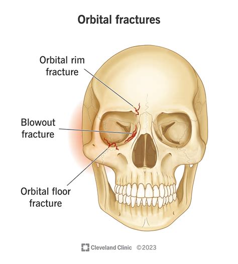 Orbital Fractures: Causes, Symptoms Treatment, 55% OFF