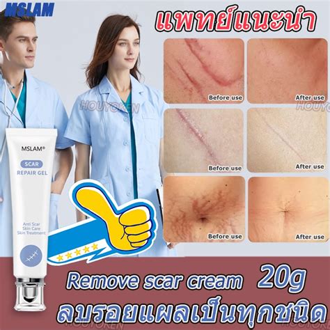 2021 รูปแบบร้อนร้อนขายราคาต่ำ 【ซื้อ1แถม1 】เห็นผลชัดเจน Vg ครีมลดรอยแผลเป็น ครีมทาแผลเป็น กำจัด