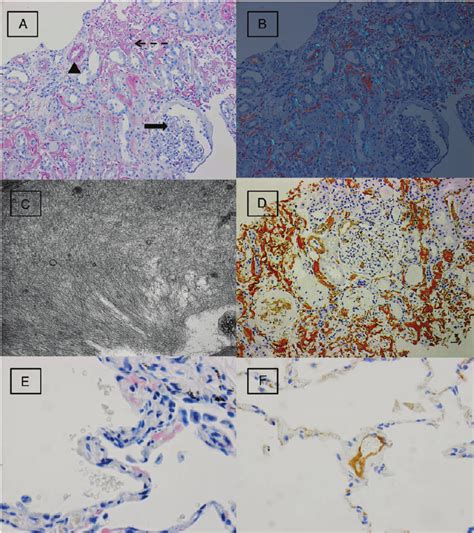 ( A ) A Congo red stain performed on kidney biopsy shows deposition of ...