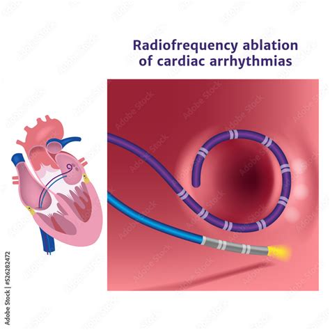 Radiofrequency Catheter Ablation Of The Heart Illustration With A