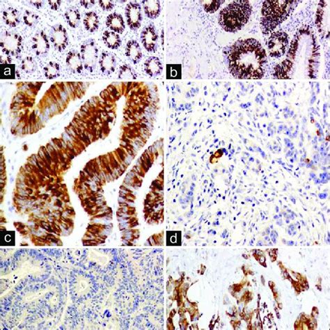 Immunostaining Of MUC2 A And B Cytoplasmic Immunostaining Of MUC2 In