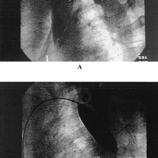 A The Suprasternal Two Dimensional Echocardiographic View Of The