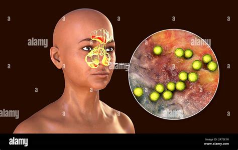 Streptococcus Pyogenes Bacteria As A Cause Of Sinusitis Computer