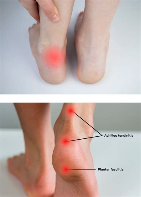 Achilles Tendinitis Pain Causes Diagnosis And Treatment