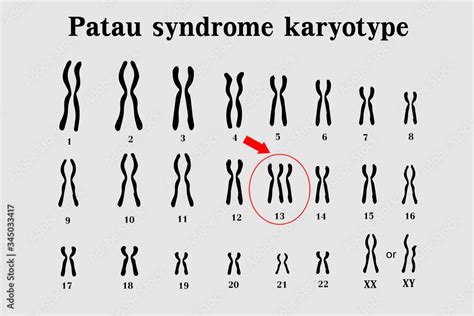 Patau syndrome karyotype is the one of chromosomal disorders that have ...