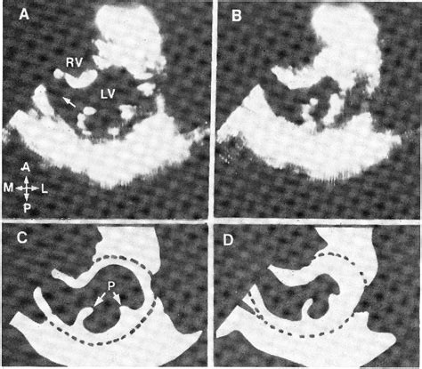 PDF Ventricular Septal Defect After Myocardial Infarction Diagnosis