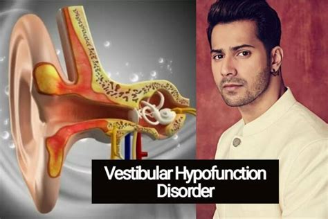 Varun Dhawan Health Update Actor Says Yoga Helps Him With Vestibular ...