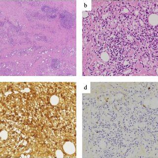 Histopathological Findings Of The Resected Specimen A Perivascular