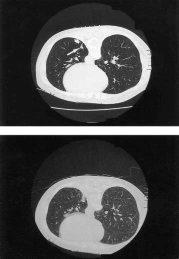 Percutaneous Needle Biopsy For Small Lung Nodules Beneath The Rib Under