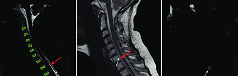 MRI Of The Spine A MR Myelography Of The Cervical Spine T2 WI In The