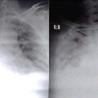 A Chest Radiographs Antero Posterior View Of Case B Chest