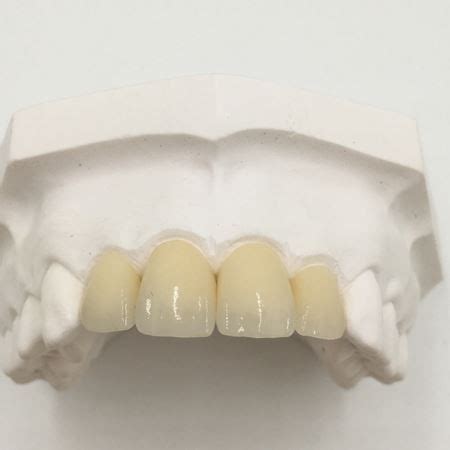 Natural Porcelain Crowns Front Teeth - News - Shenzhen Diamond Dental ...