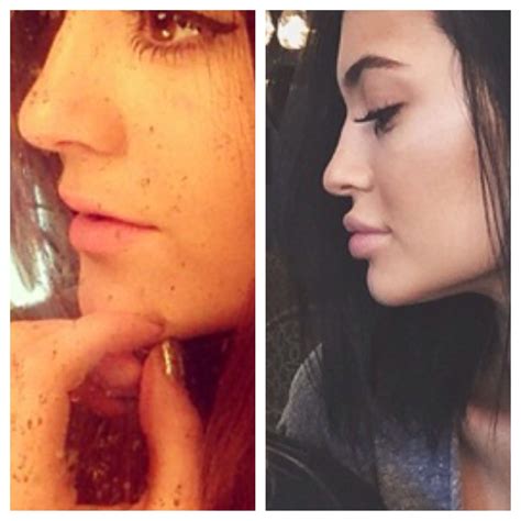 Kylie Jenner before and after her lips! | Kylie jenner before, Plastic ...