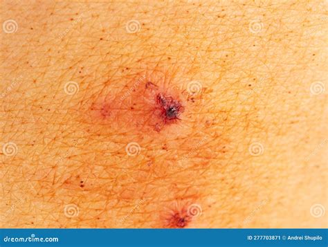 Ringworm Skin Infection Dermatophytosis Mycosis On The Human Leg