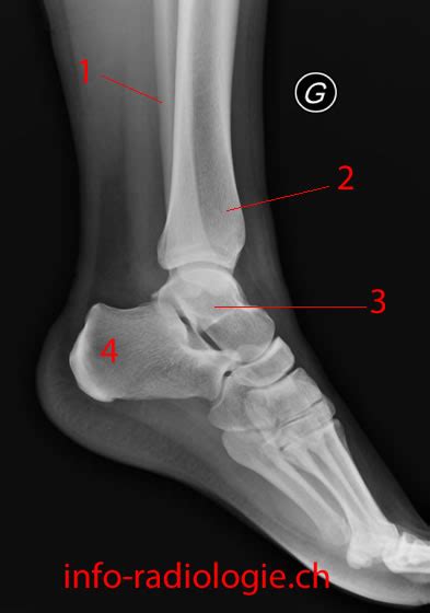 Fracture malléole interne