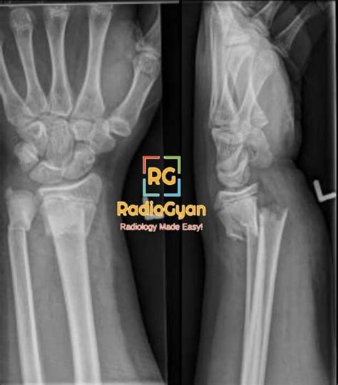 Colle Fracture Distal Radius Imaging And Diagnosis