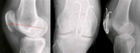 Tell Klinik Osteosynthese Bei Frakturen Im Kniebereich Und Des