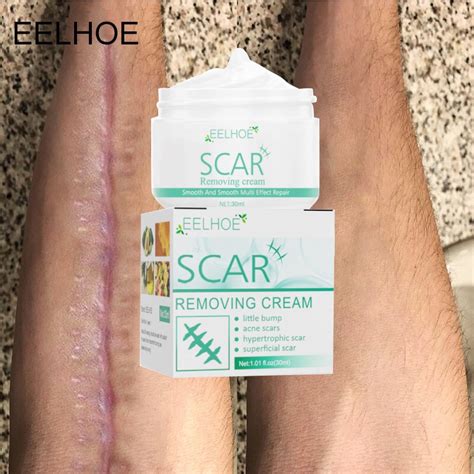 Effective Scar Remover For Old Scar On Leg Scar Gel Original Stretch