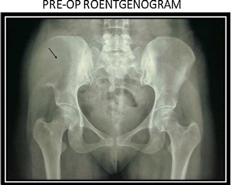 Pre Operative X Ray Pelvis Antero Posterior View Download Scientific