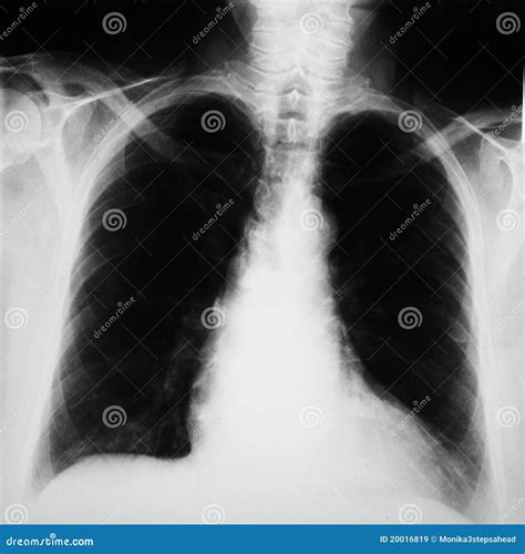 Radiograph Of Human Chest Royalty Free Stock Images - Image: 20016819