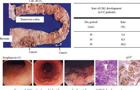 Figure 1 From Development Of An Inflammation Associated Colorectal