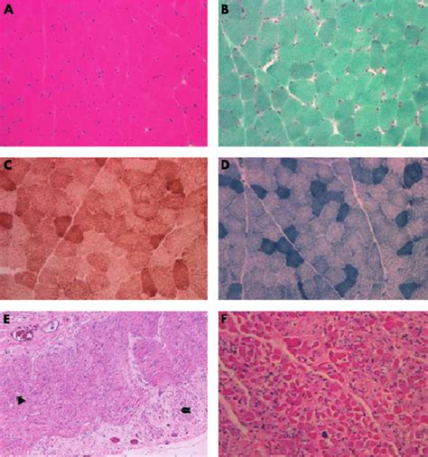 Muscle Histopathology Pathological Specimens Showing Normal Skeletal