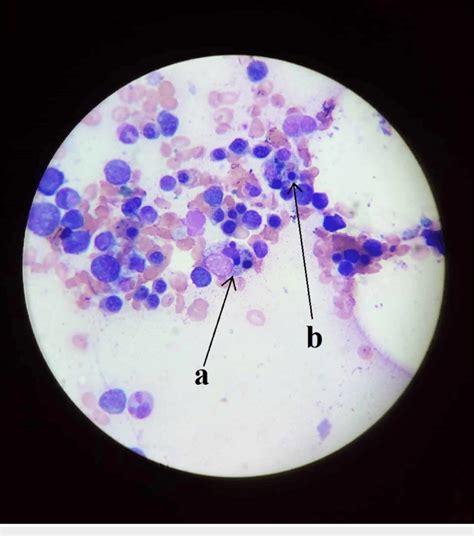 Bone Marrow Biopsy Showing Hemophagocytosis And Lupus Erythematosus