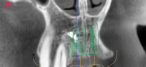 Guided Surgery Along With Two Sinus Augmentations Noris Medical