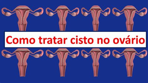 Cisto No Ovario Pode Atrasar A Menstrua O