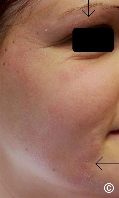 Tinea Faciei Face And Barbae Beard