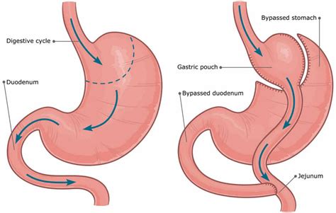 Laparoscopic Gastric Bypass Gisborne Surgical Associates