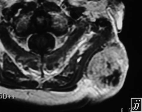 Occipital Extra Cranial Tumor Radiopaedia